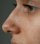 גידולים באף: הסימפטומים, האבחון והטיפול-תמונה